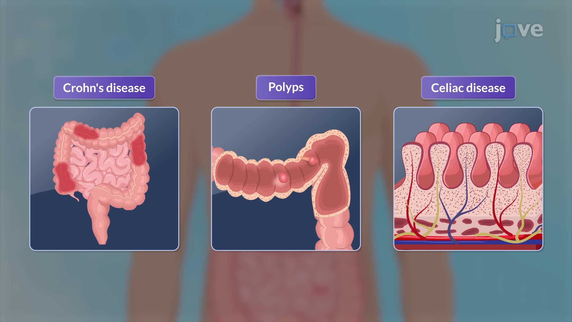 Endoscopy procedure
